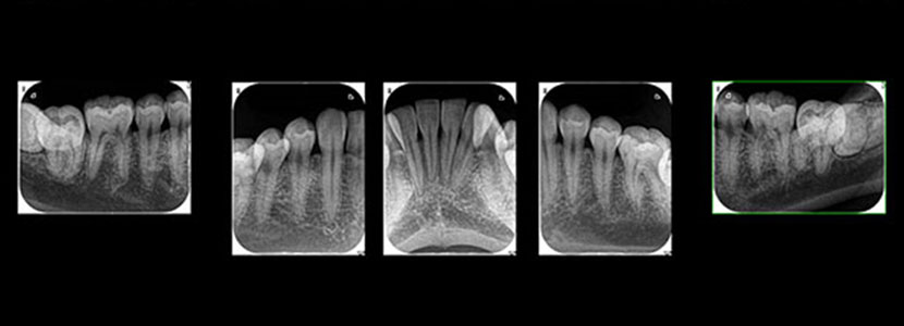 デンタルレントゲン検査 • あすなろ歯科
